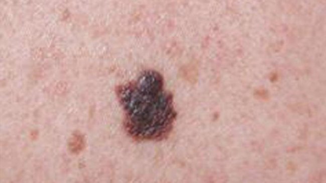 Desarrollan campaña que busca la prevención efectiva del cáncer a la piel en el Maule