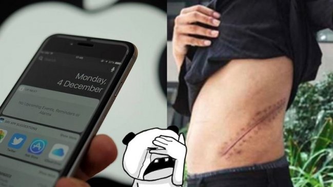 Joven vendió su riñón para comprar un iPhone y quedó con graves secuelas