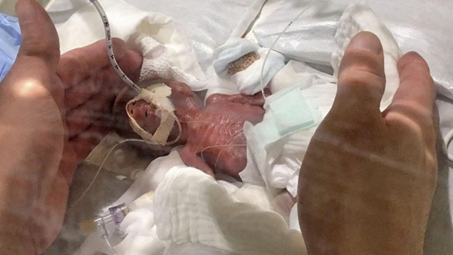 Japón: El bebé más prematuro y más pequeño de la historia fue dado de alta