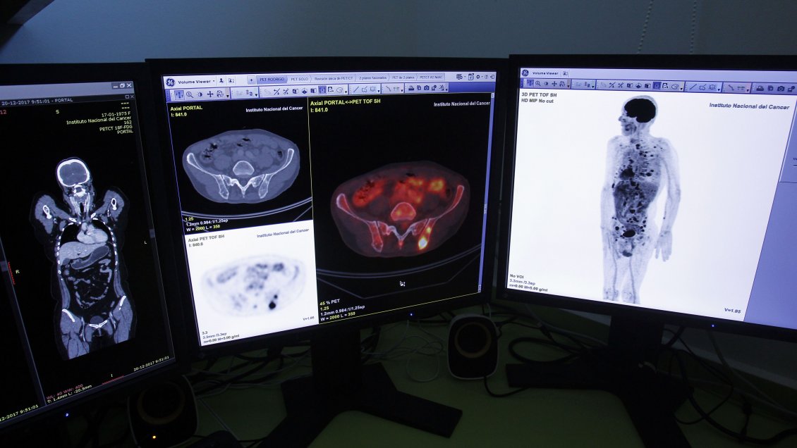 Cáncer de Colon supera al digestivo en Chile