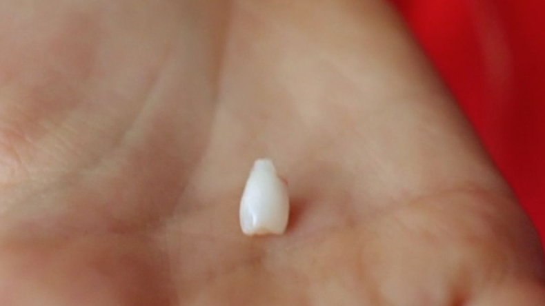 Dientes de leche pueden ser claves para tratar cáncer e infartos