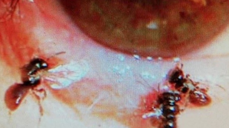 Médicos encontraron abejas en el ojo de una mujer: Se alimentaban de sus lágrimas