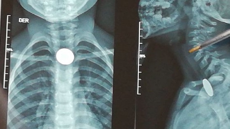 Niño se tragó una moneda y lleva una semana sin que se la puedan sacar