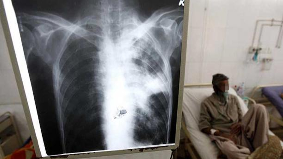 Autoridades confirmaron que profesora de Alto Hospicio padece tuberculosis