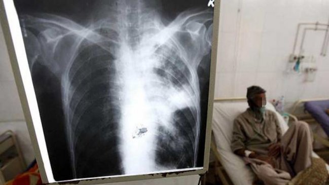 Autoridades confirmaron que profesora de Alto Hospicio padece tuberculosis