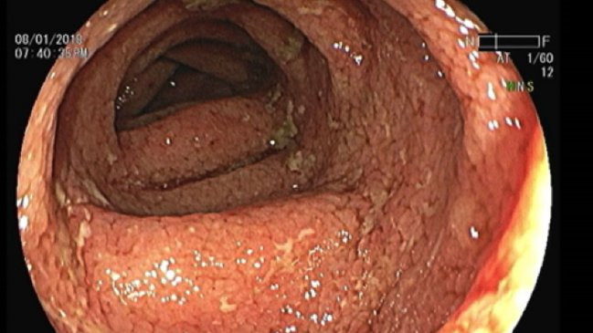 Colitis ulcerosa: La nueva enfermedad que ingresará a la Ley Ricarte Soto