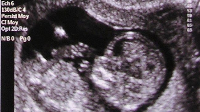 Aborto a niña violada de 14 años se convirtió en parto prematuro