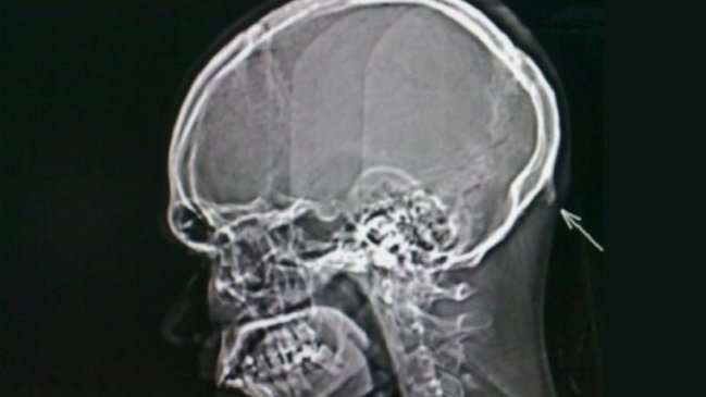 Uso de teléfonos está provocando que a los humanos les salga un nuevo hueso en el cráneo