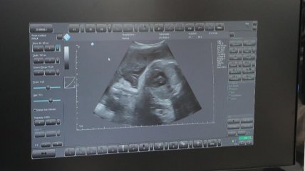  Un hito chileno: ¿Cómo se logró la primera ecografía a distancia?  