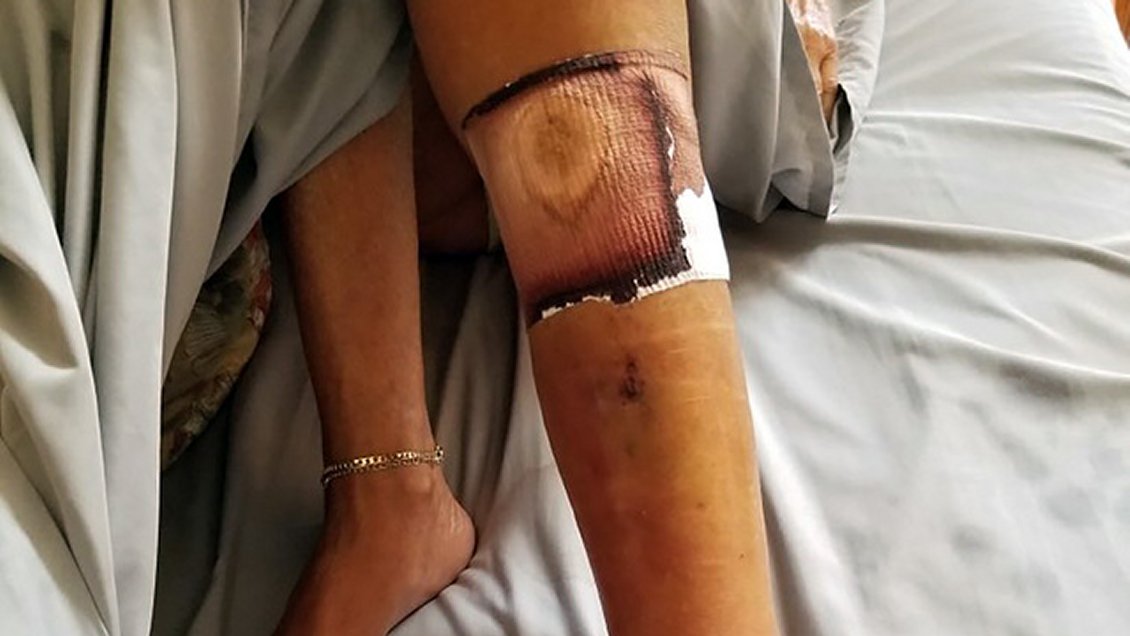 Mujer murió tras contraer la bacteria 