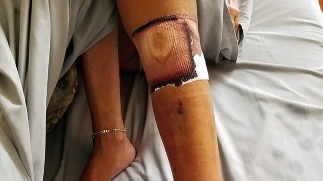 Mujer murió tras contraer la bacteria 