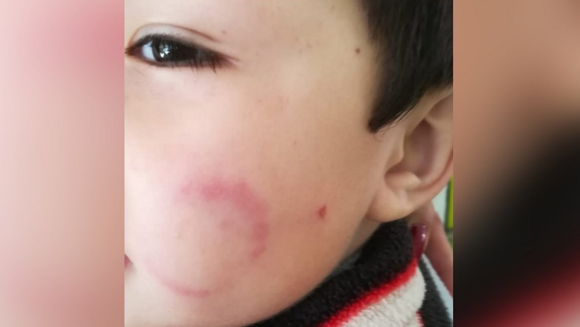 Joven madre recibió a su hijo mordido y arañado desde un jardín infantil Junji