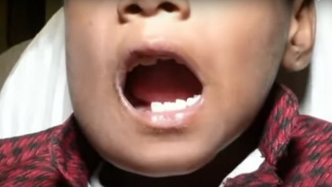 Niño fue al dentista por dolor de mandíbula y le encontraron 526 dientes