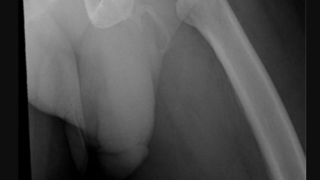Hombre se cayó y descubrió que su pene se estaba convirtiendo en hueso