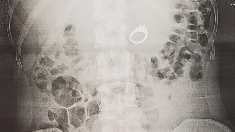 Soñó que le querían robar su anillo de compromiso y se lo tragó para esconderlo