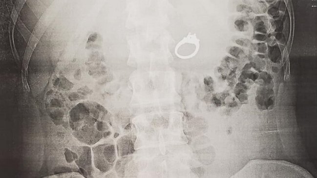 Soñó que le querían robar su anillo de compromiso y se lo tragó para esconderlo