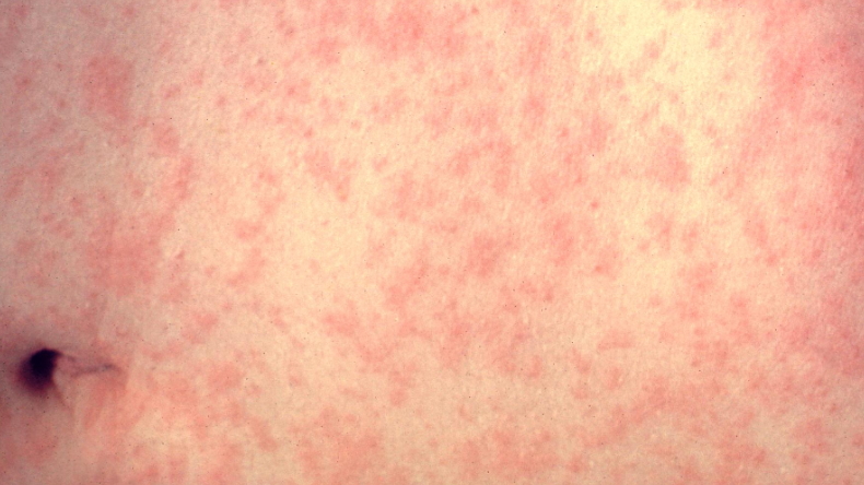 Madre antivacunas contagió a sus cinco hijos de sarampión