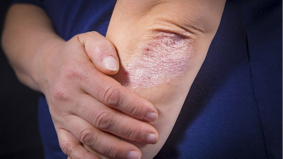 Dermatólogo: Padecer psoriasis eleva el riesgo de tener otras enfermedades físicas y psicológicas