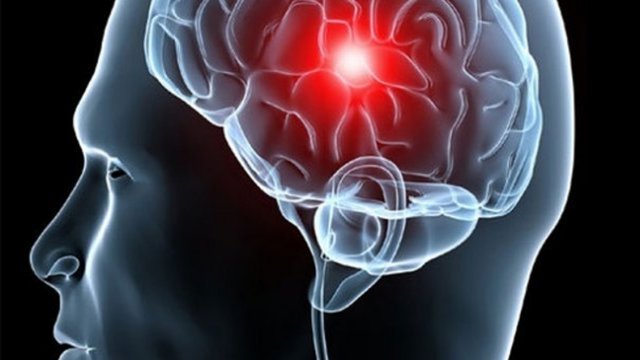 ¿Cómo prevenir un accidente cerebrovascular?