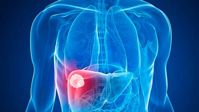 Científicos encuentran nueva estrategia potencial para tratar enfermedad de hígado graso