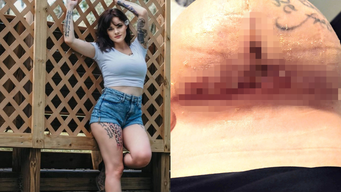 Mujer fue a hacerse reducción de senos: Despertó con implantes y liposucción