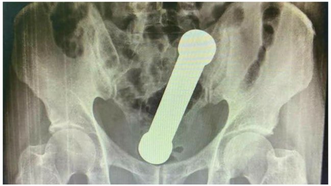 Encuentran una mancuerna de dos kilos en el recto de un hombre con dolor de estómago