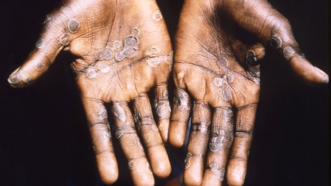 Casos globales de viruela del mono ascienden a casi 14 mil en más de 70 países