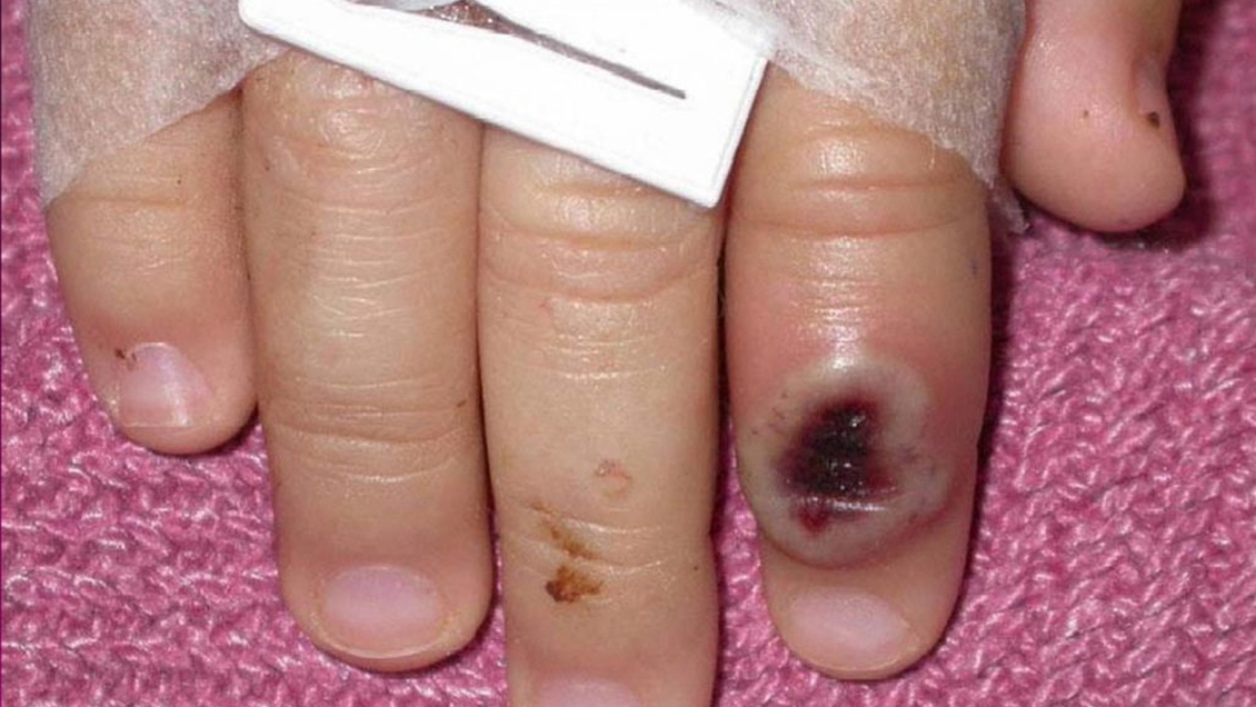 Imágenes fuertes: Estrella porno compartió su experiencia tras contagiarse viruela del mono