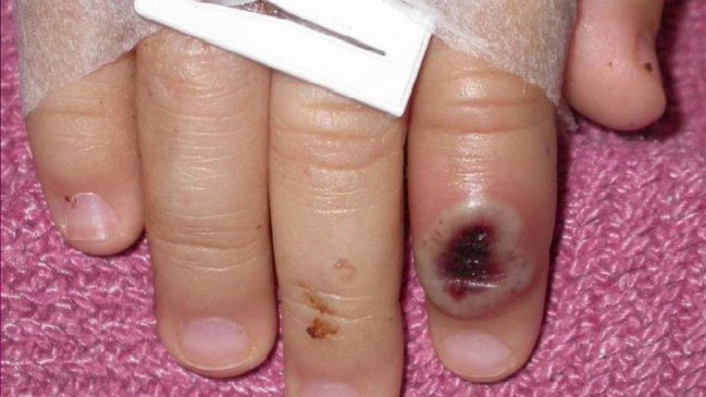 Imágenes fuertes: Estrella porno compartió su experiencia tras contagiarse viruela del mono