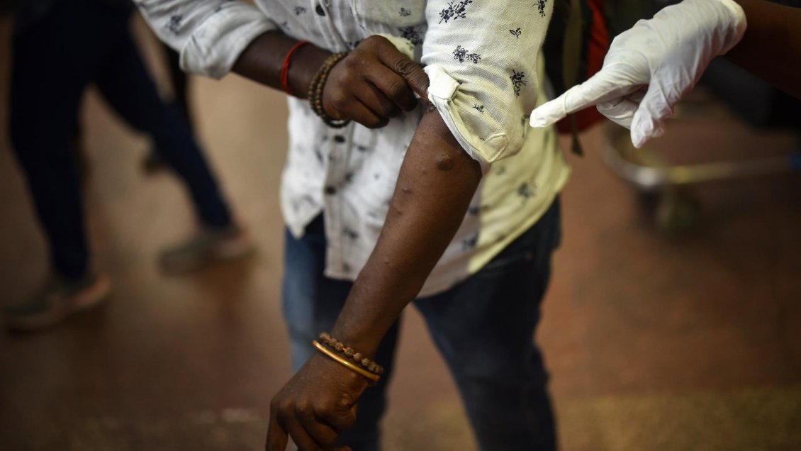 Brasil y España reportan sus primeras muertes por la viruela del mono