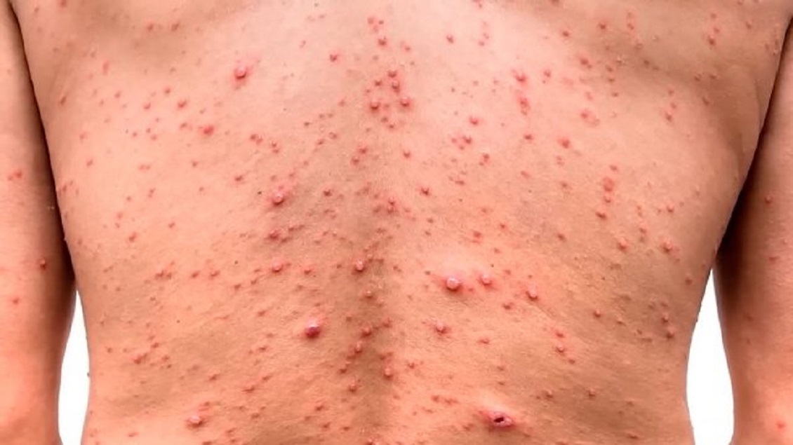 Confirmaron primer caso de viruela del mono en el Biobío