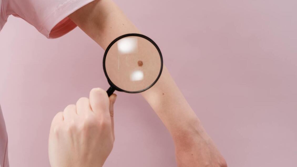 Incidencia de melanoma aumentó 600 veces en el mundo en 20 años