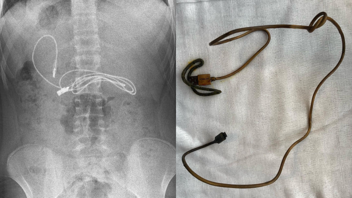 Médicos extrajeron cable USB de un metro de largo del estómago de un adolescente