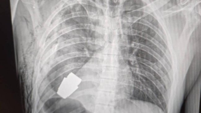 Médicos extrajeron una granada sin explotar del pecho de un soldado ucraniano