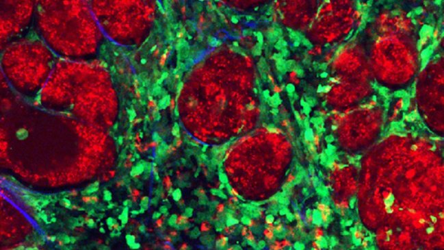 Científicos descubren por qué fracasan algunos compuestos antitumorales