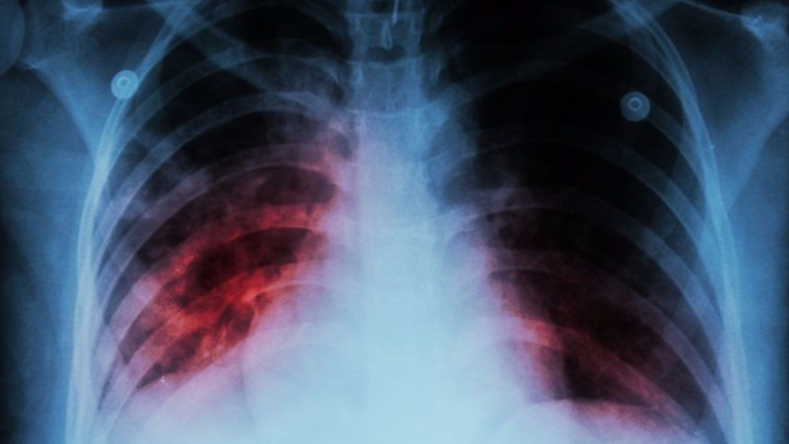 Detectan un caso de tuberculosis en colegio de Viña del Mar