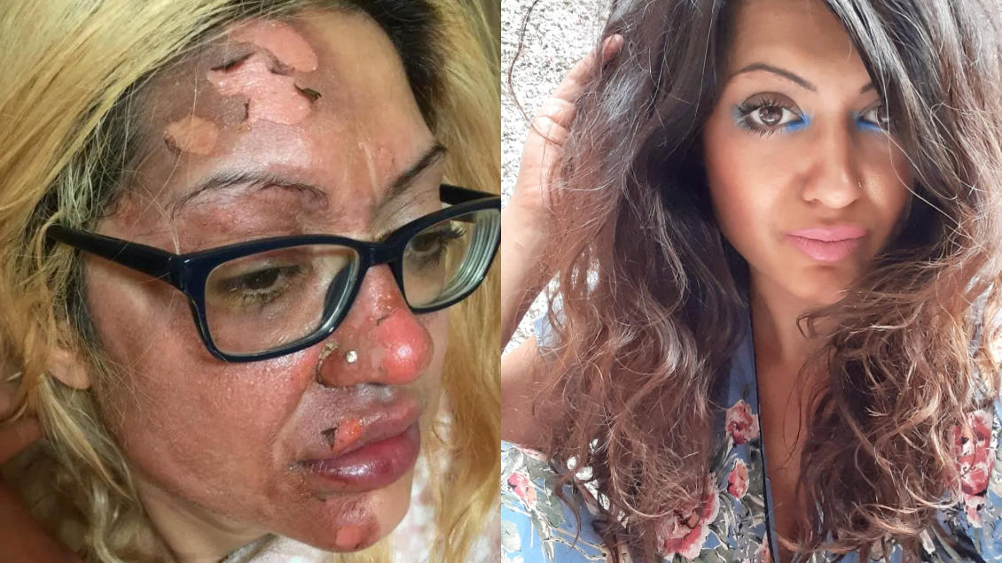 Siguió un tutorial de TikTok y terminó con graves quemaduras: 