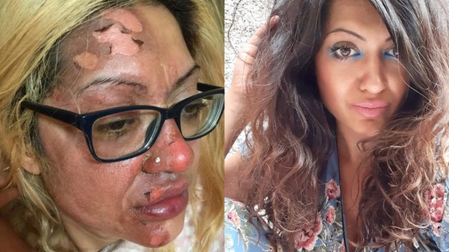 Siguió un tutorial de TikTok y terminó con graves quemaduras: 