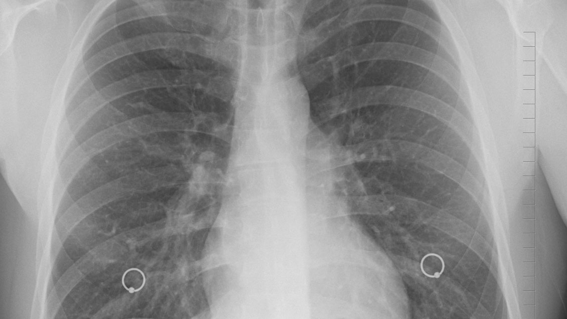 Nuevo tratamiento aumenta la supervivencia en pacientes con cáncer de pulmón