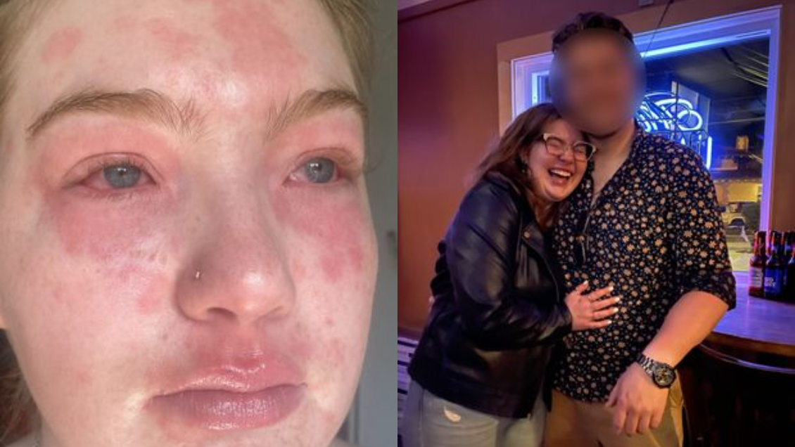 Joven asegura ser alérgica a su pololo y divide a redes: 