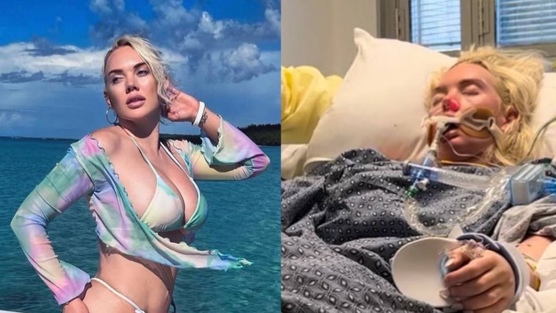 Modelo fue amputada de una pierna tras ataque de 