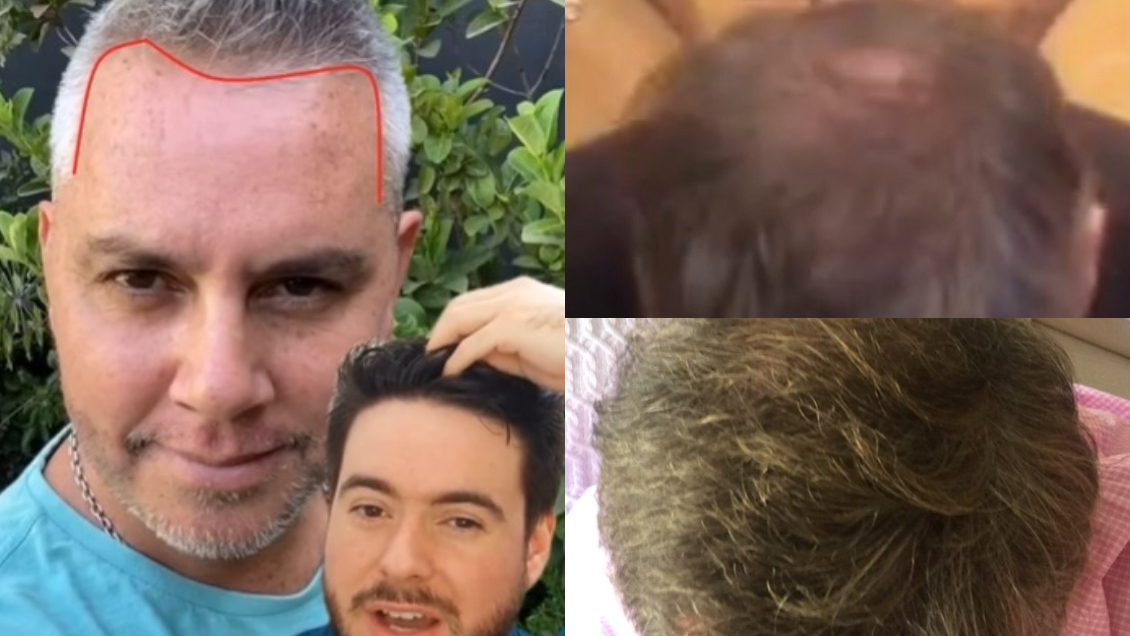 ¿Cirugía de trasplante capilar? José Miguel Viñuela confesó qué se hizo en el pelo