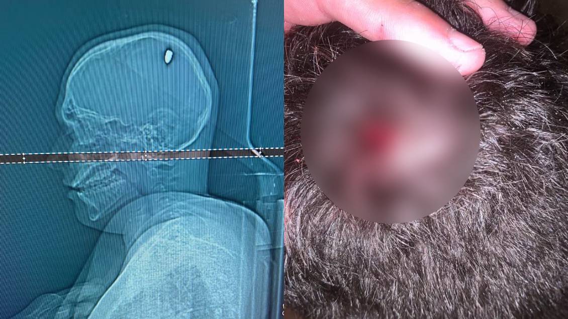 Pensó que lo golpearon con una piedra en la cabeza, y en realidad fue alcanzado por una bala