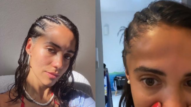 Joven terminó con la cabeza hinchada al hacerse trenzas en Brasil