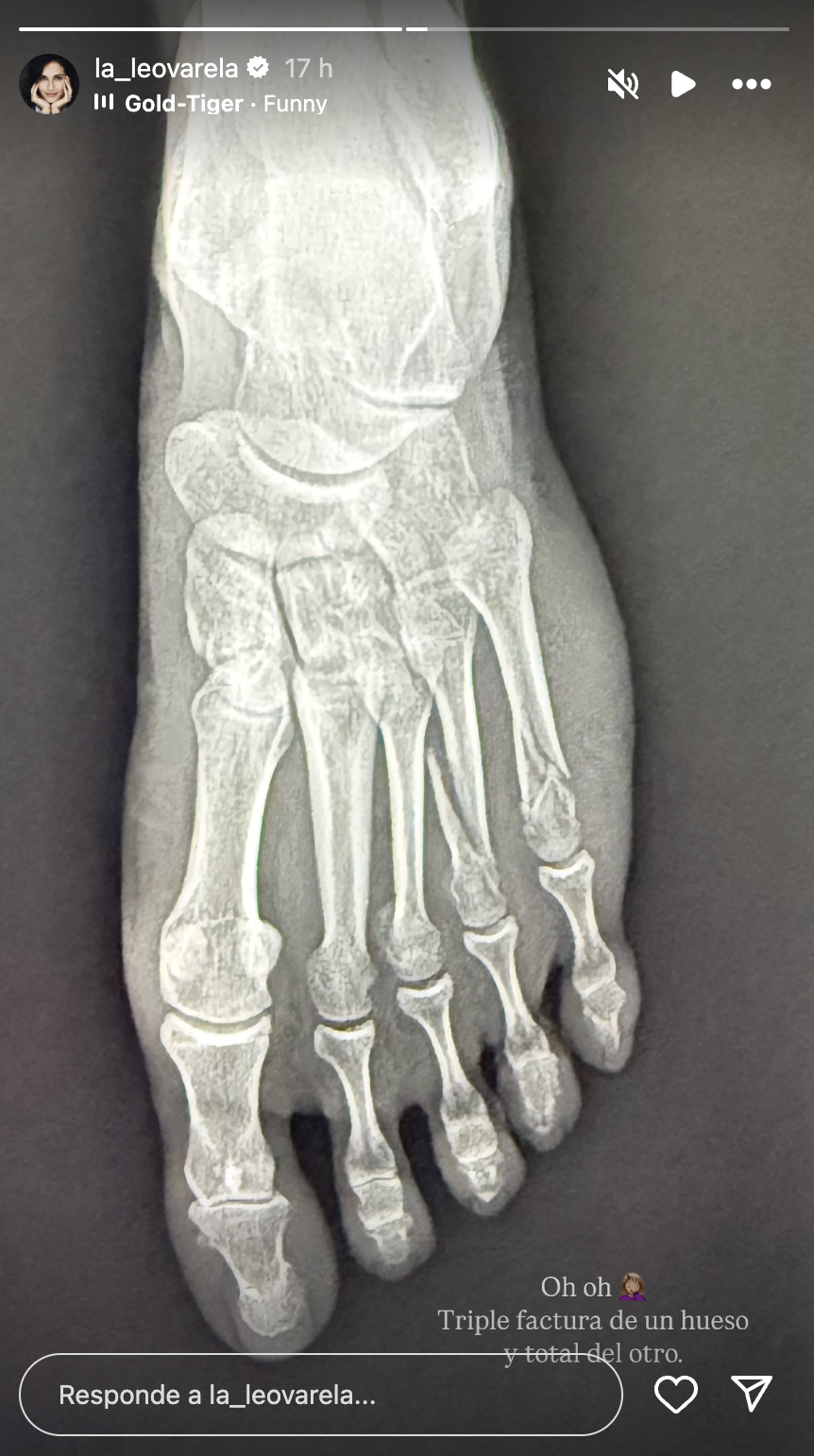 Leonor Varela se fracturó Leonor Varela accidente