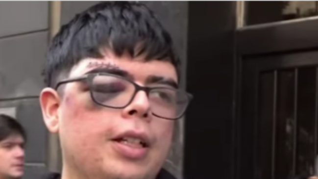 Hincha de la U y sus lesiones: No me dejan viajar en avión porque me puede explotar el ojo