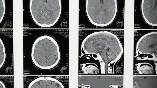 Una investigación británica vincula la menopausia con síntomas similares al Alzheimer