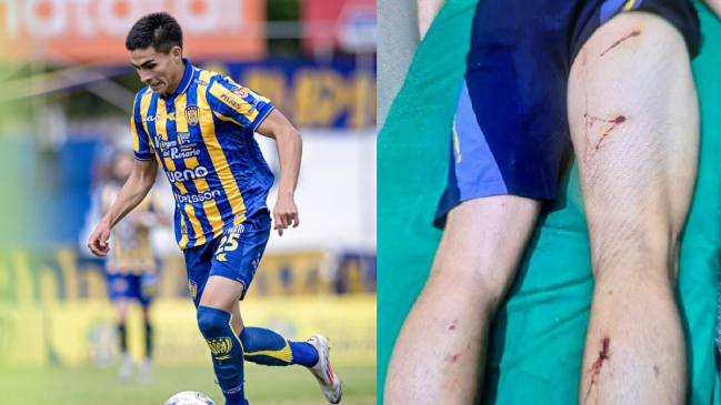 Jugador sufrió quemaduras tras ataque con pirotecnia al plantel de Sportivo Luqueño