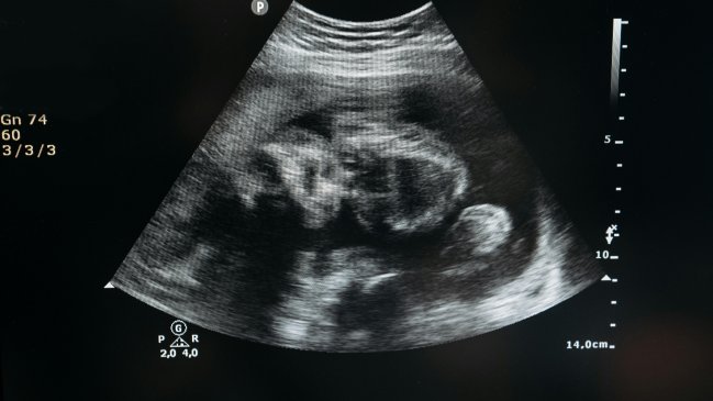 Consumir alimentos ultraprocesados afecta la fertilidad humana y el desarrollo del feto