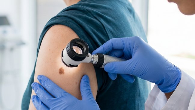 Muertes por cáncer a la piel aumentaron 60% en la última década en Chile